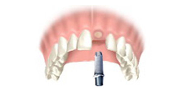 image-implant-une-dent