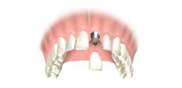 image-implant-une-dent