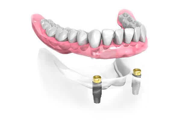 Prothèse dentaire complète sur implants