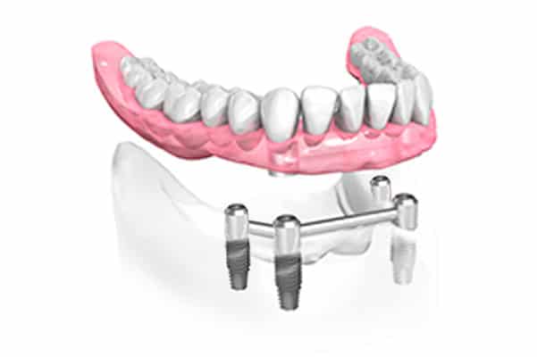 Prothèse dentaire complète sur implants avec barre