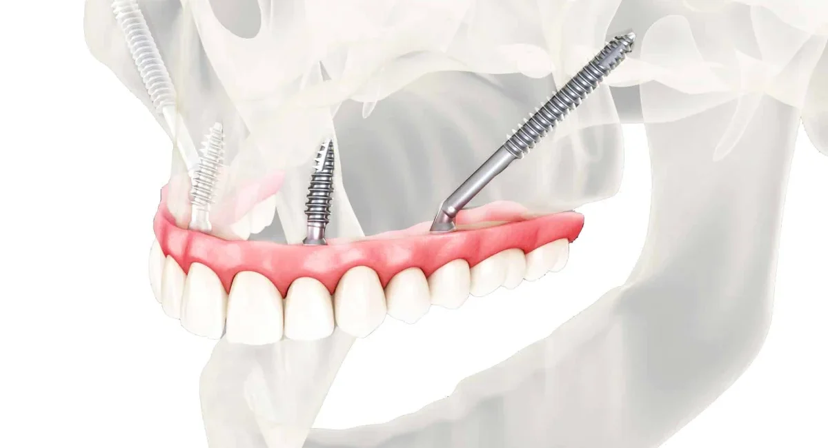 Implants-dentaires-1