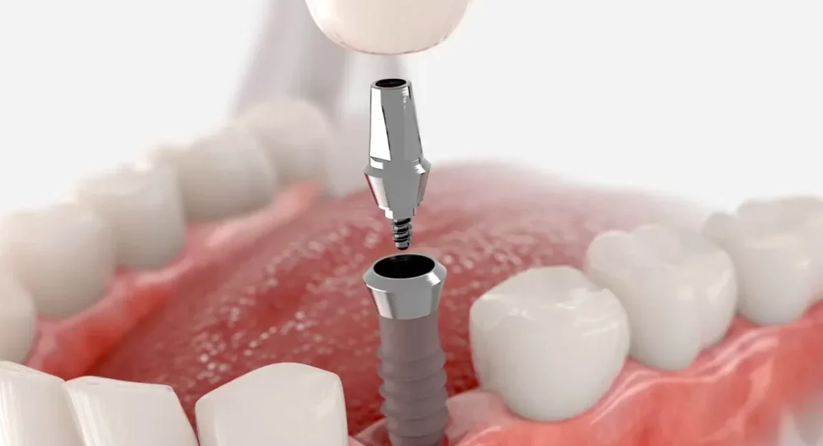 Implants-dentaires-2