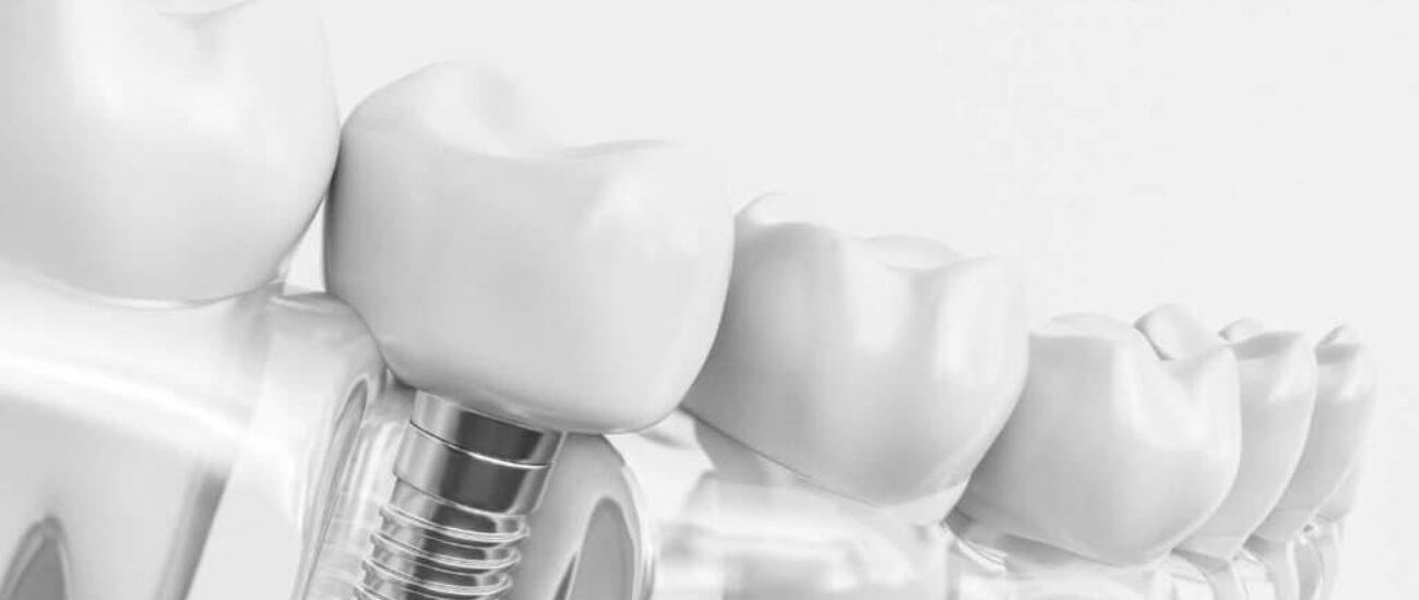 Tarif Pose de couronne sur implant