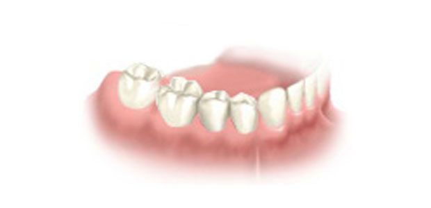 image-implant-une-dent