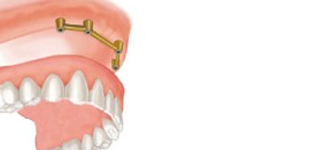image-implant-une-dent