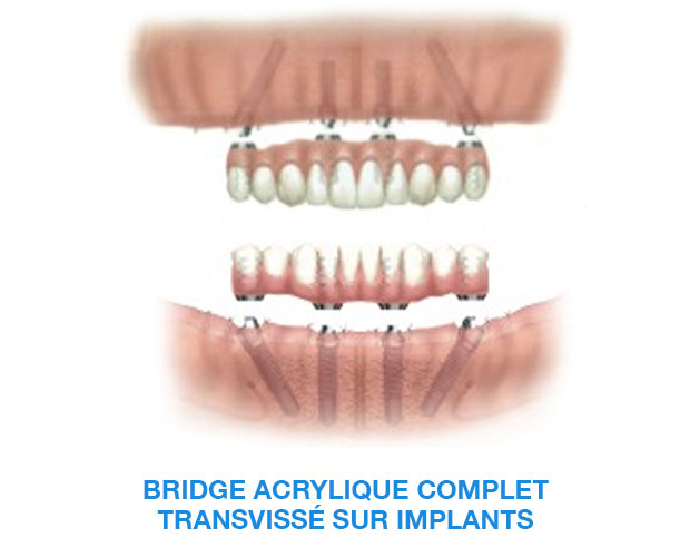 image-implant-une-dent