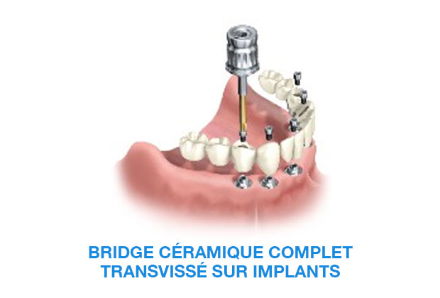 image-implant-une-dent